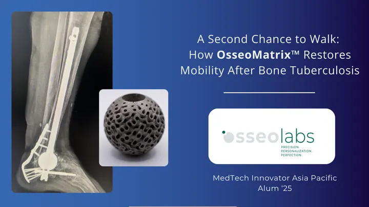 A Second Chance to Walk: How OsseoMatrix™ Restores Mobility After Bone Tuberculosis