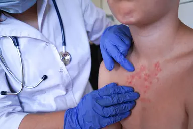 Clinical examination of a patient presenting with a characteristic rubella-like rash, supporting infectious disease diagnosis and surveillance.