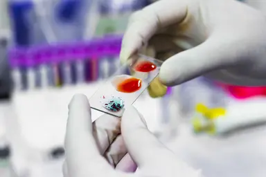 Laboratory professional examining a microscope slide with biological specimens during diagnostic testing procedures