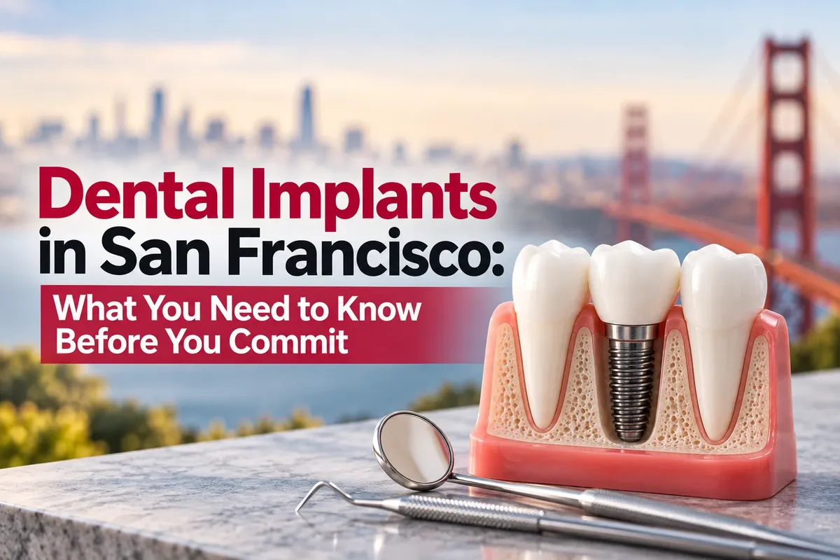 Dental Implants in San Francisco: What You Need to Know Before You Commit
