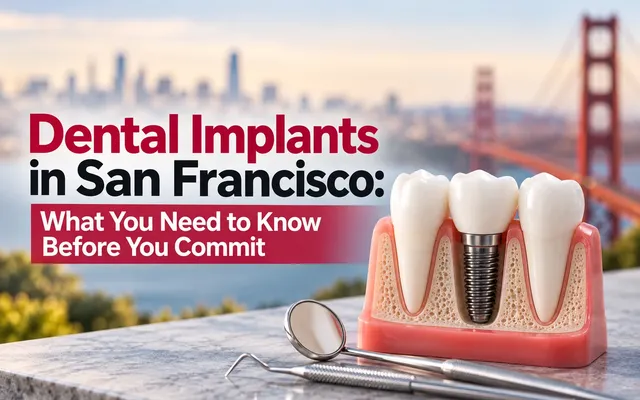 Dental Implants in San Francisco: What You Need to Know Before You Commit