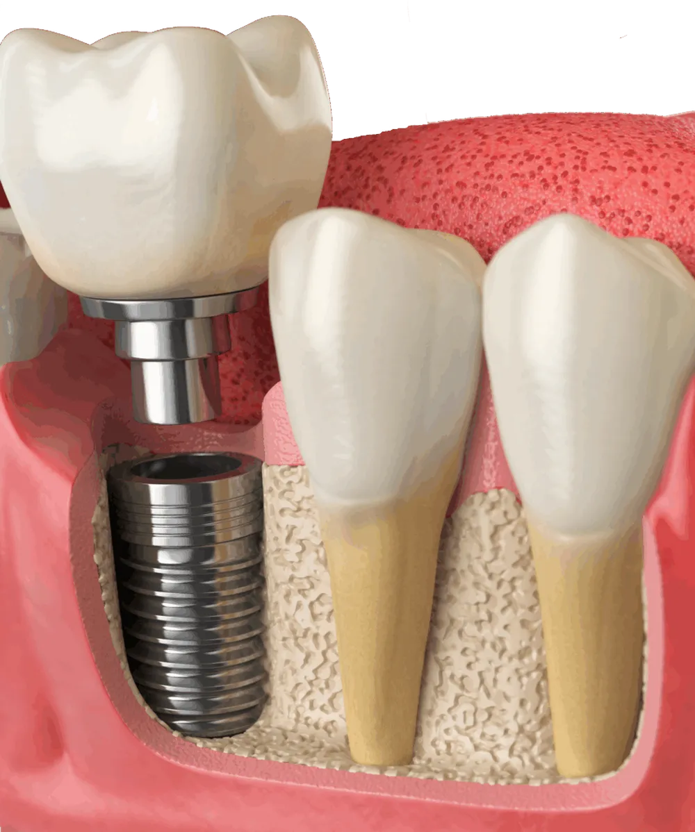 Implantes All-on-Six en Valdivia: sonrisa fija con solo 6 implantes