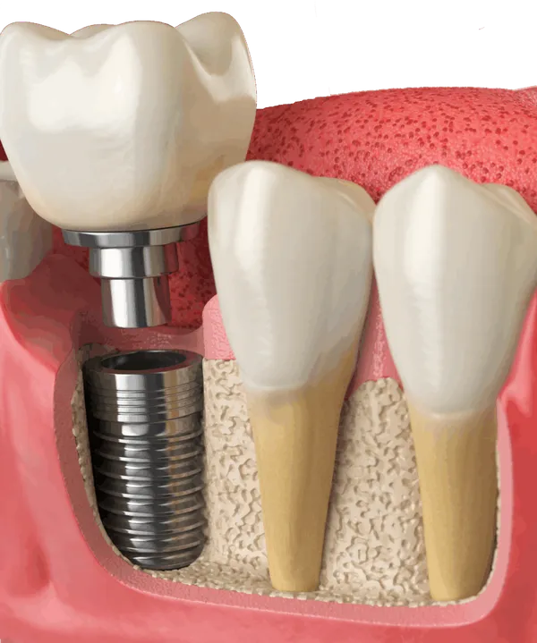 Implantes All-on-Six en Valdivia: sonrisa fija con solo 6 implantes