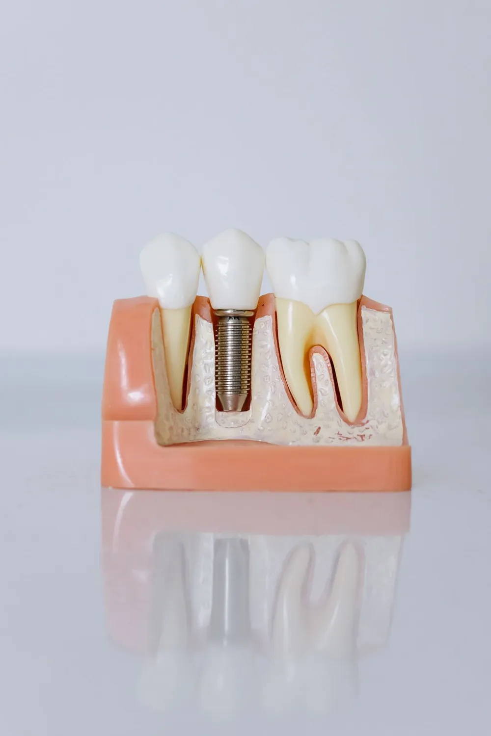Cuidados después de un implante dental: la guía para una recuperación sin sobresaltos