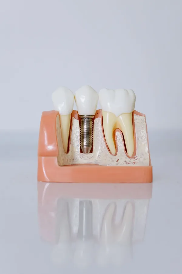 ¿Perdiste varios dientes? No siempre necesitas un implante por cada uno