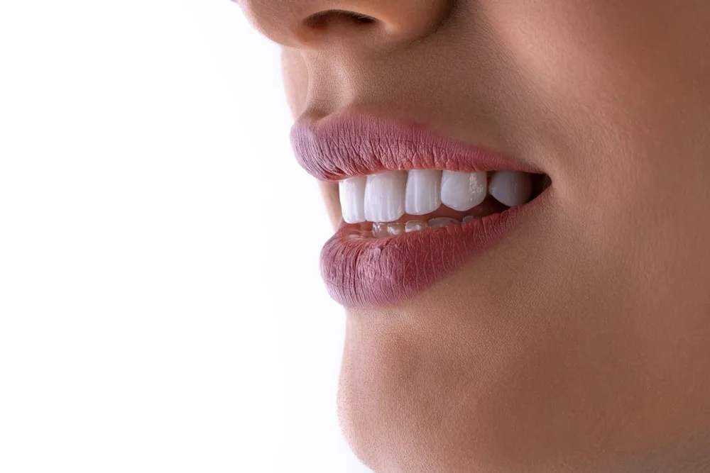 Blanqueamiento dental + limpieza