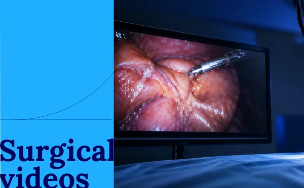 Subcostal Right Lower Lobectomy