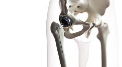 Average Hip Replacement Cost in the United States