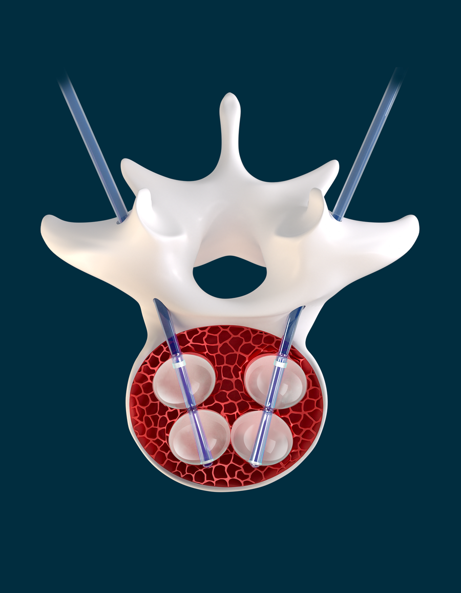 Double-balloon catheter