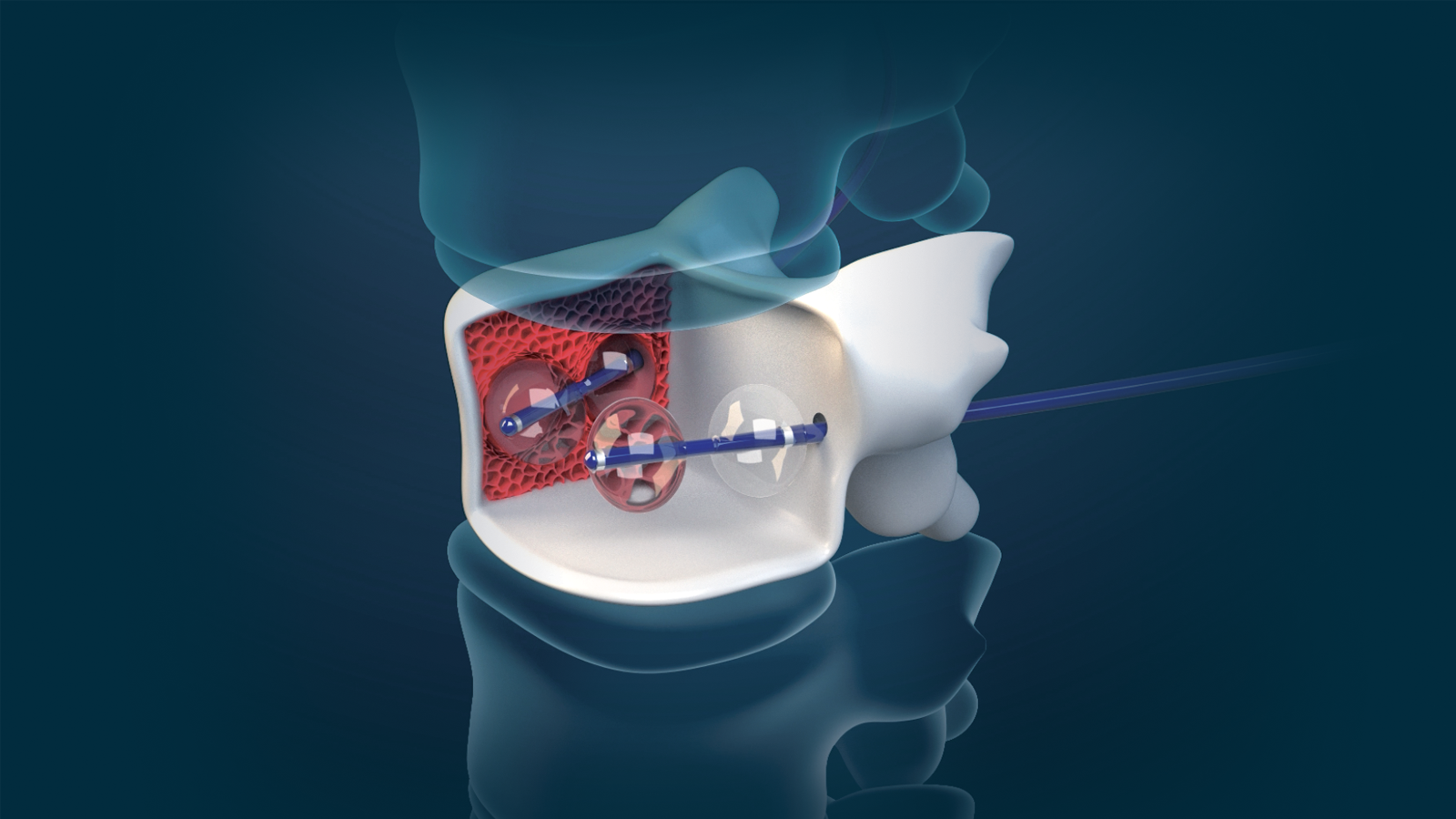 Jusline Injection Your partner for minimally invasive treatment solutions | Joline