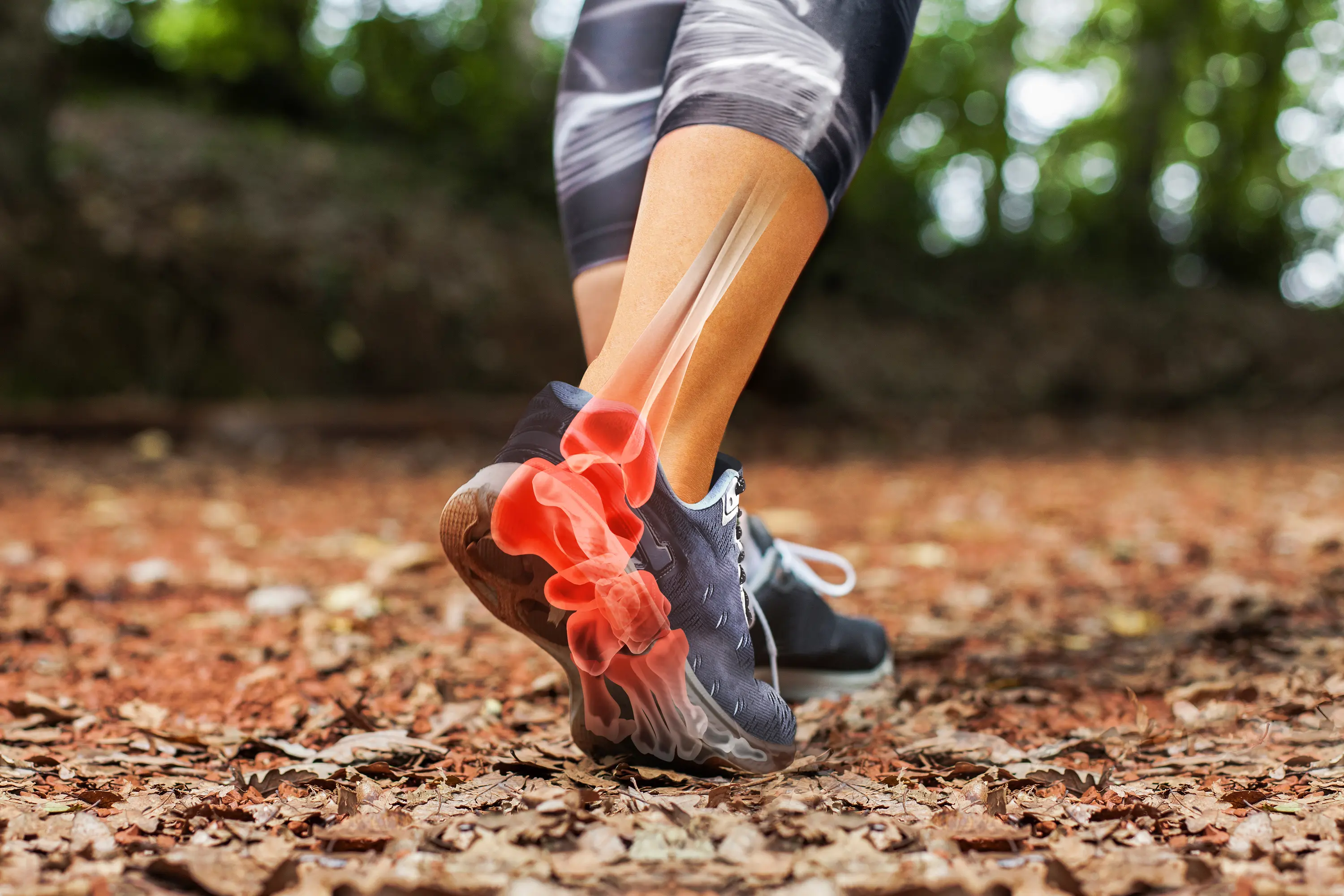 Achilles tendinopathy  pain