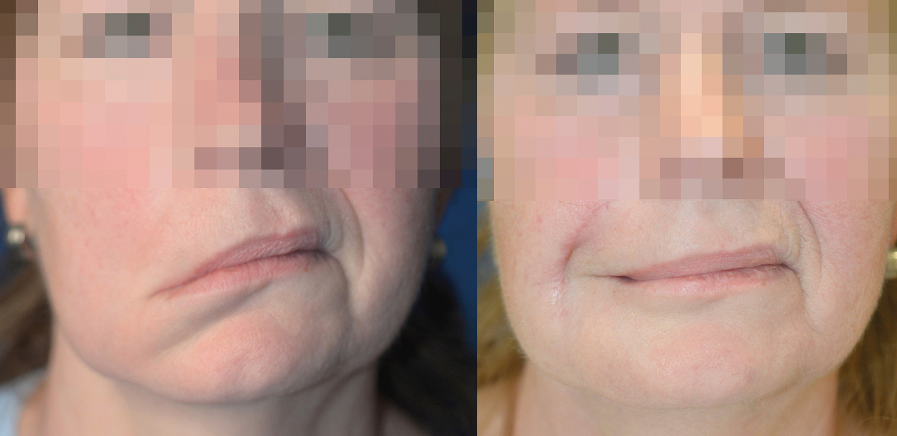 Links ein Foto vor der fazialen Reanimation, rechts ein Foto nach der fazialen Reanimation