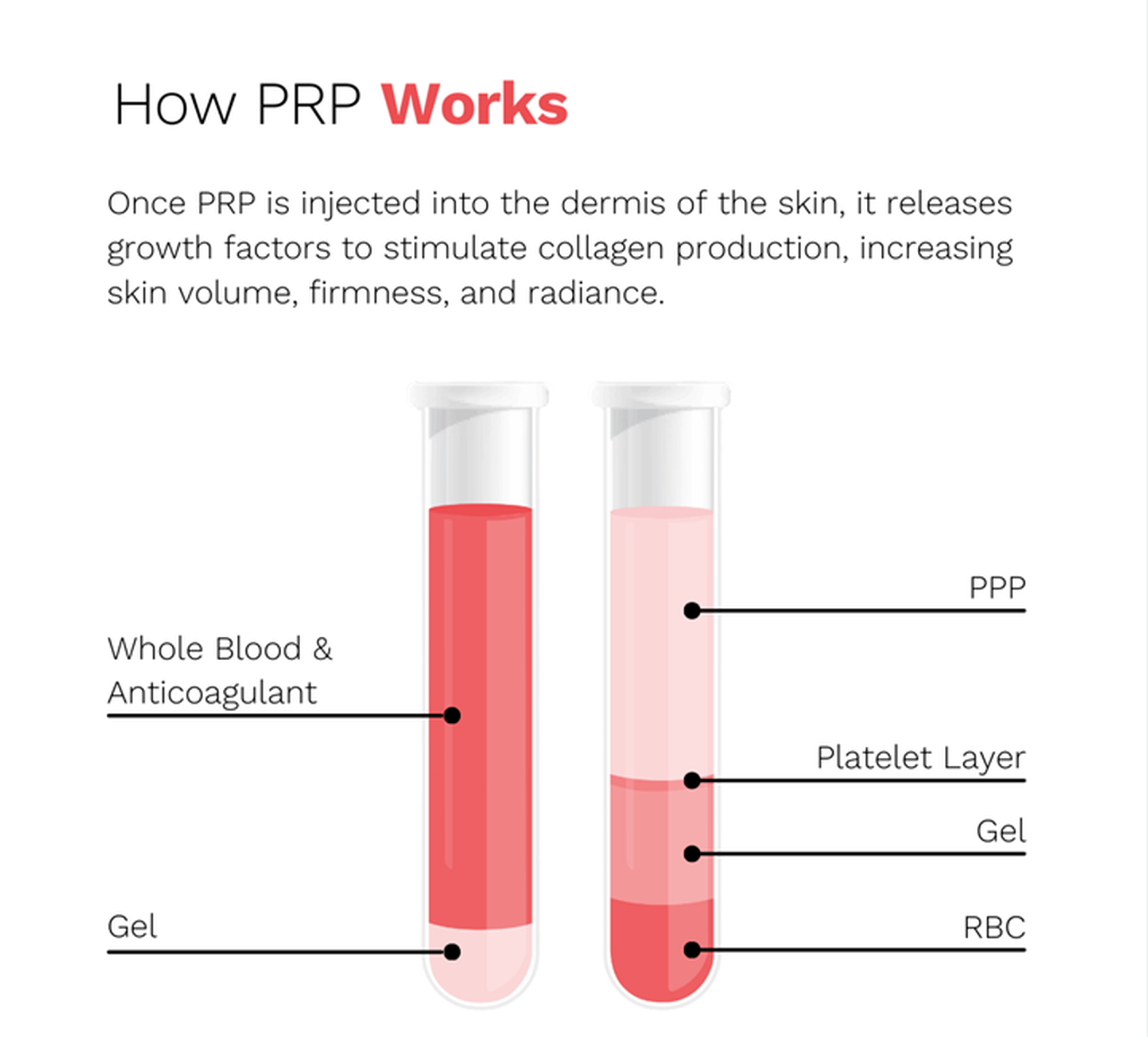 Platelet-Rich Plasma (PRP) | Laser Clinics Canada