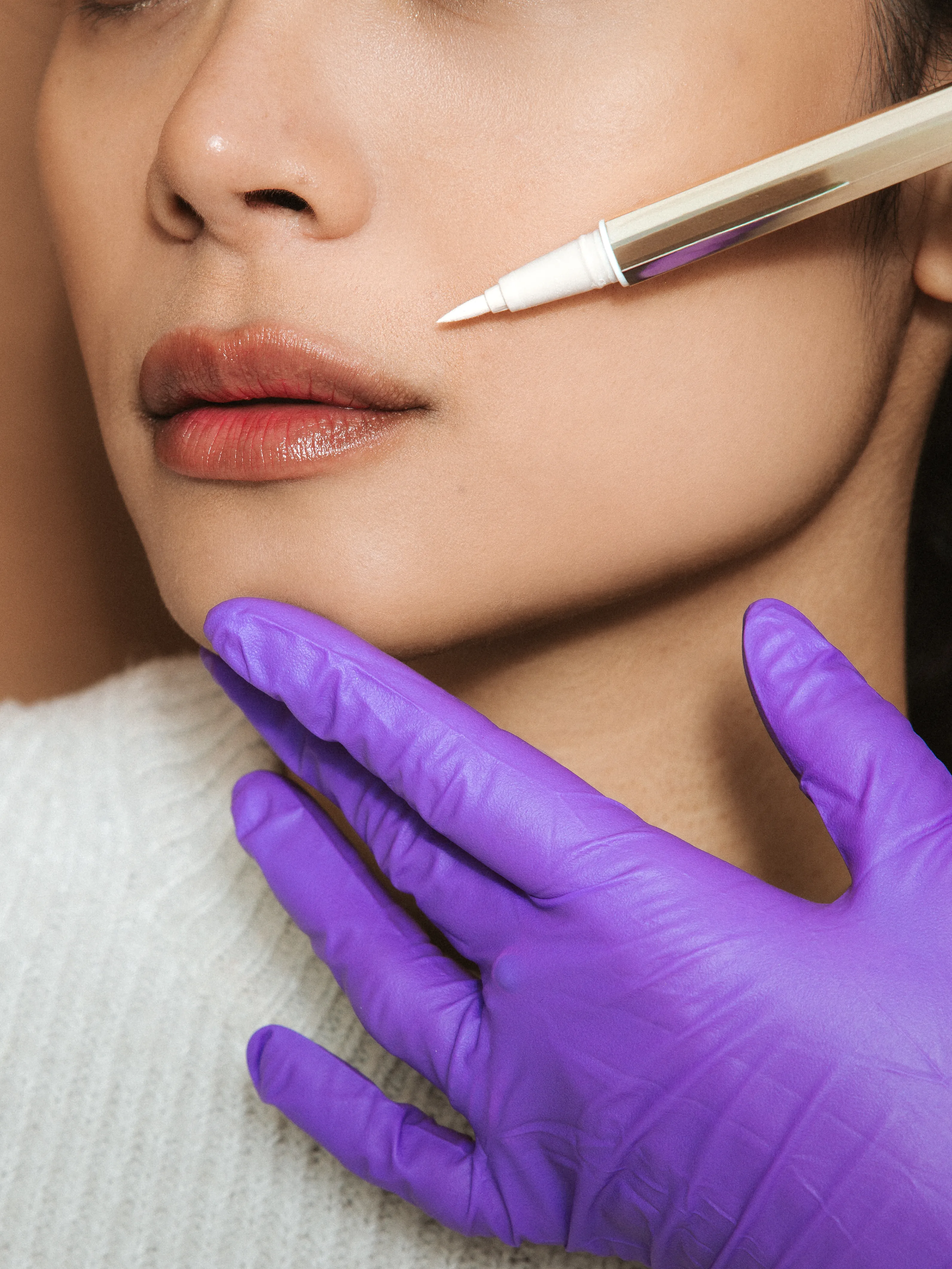 Close-up van een botox-behandeling rondom de mond bij Soap