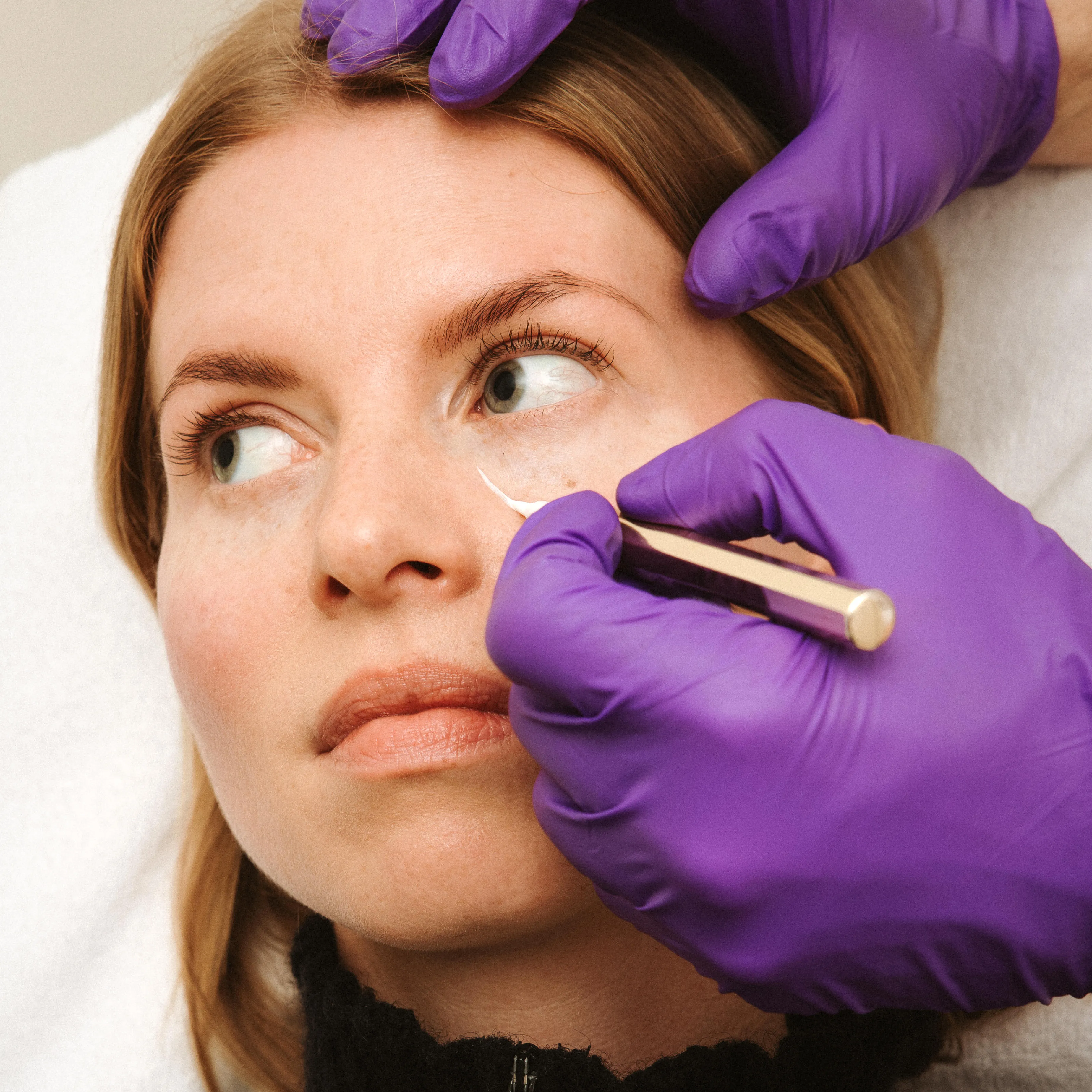 Arts van Soap tekent het voorhoofd van een cliënte af voor een botox treatment