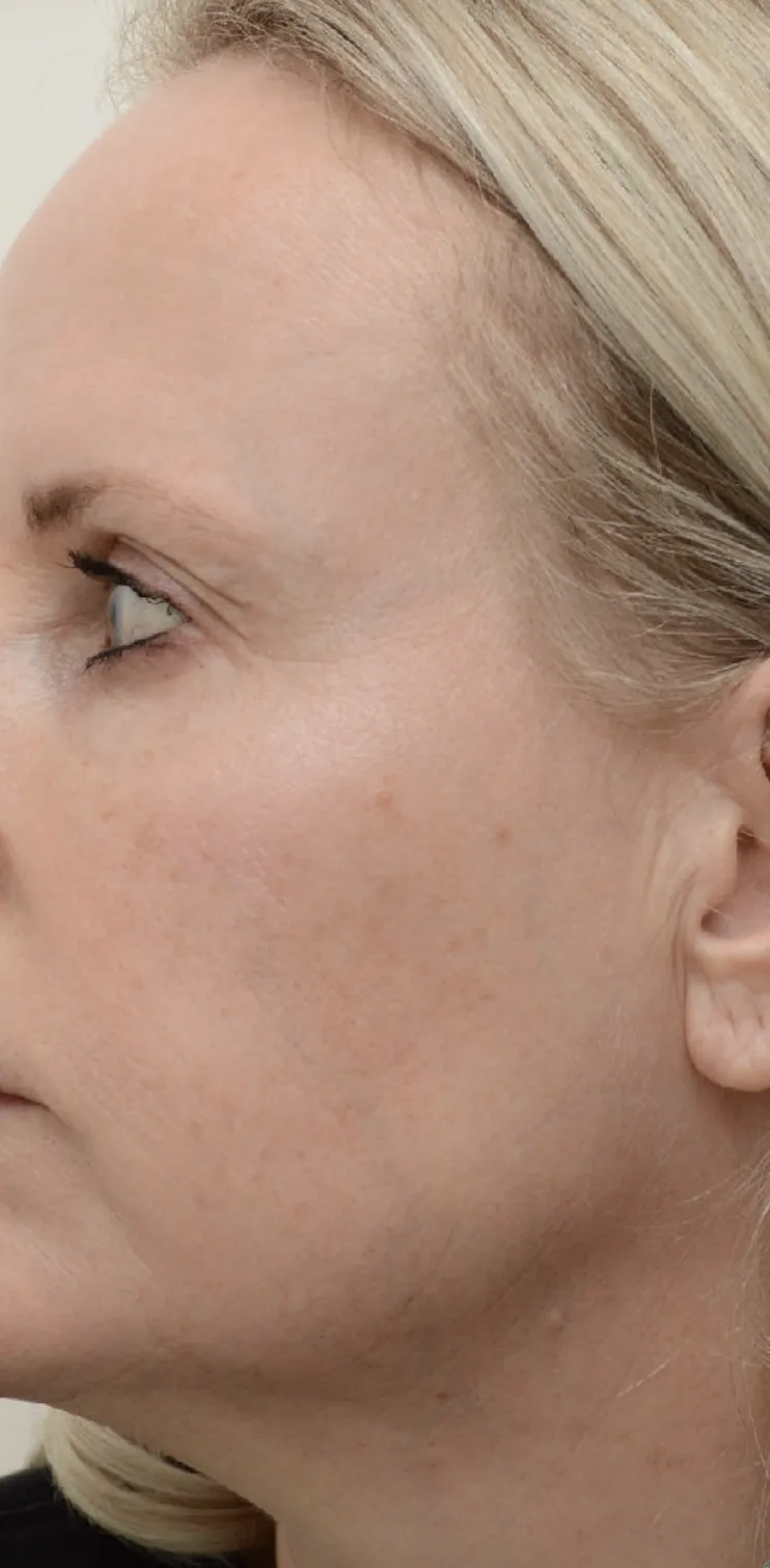 laser-facial-after