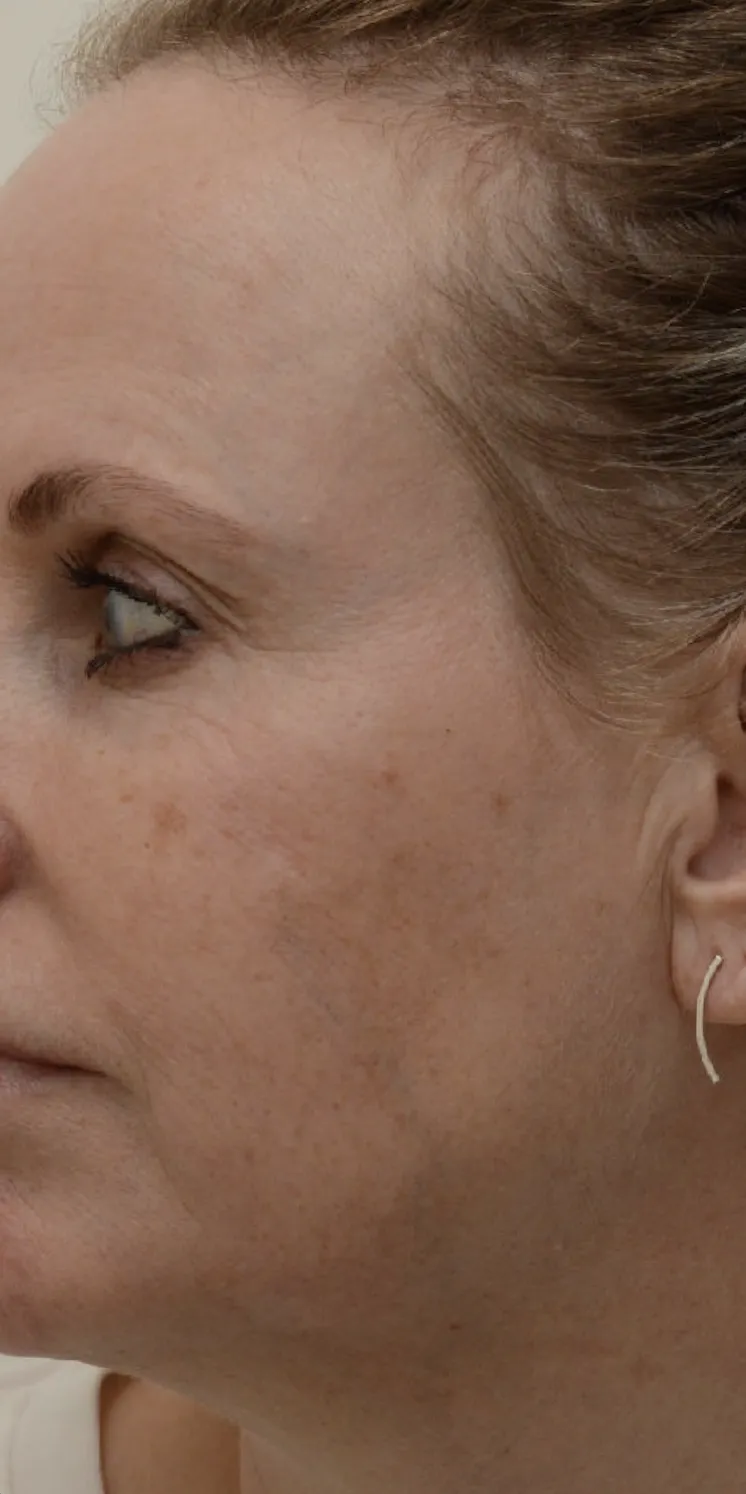 laser-facial-before
