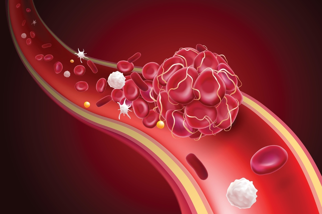 Blood clot within blood vessel.