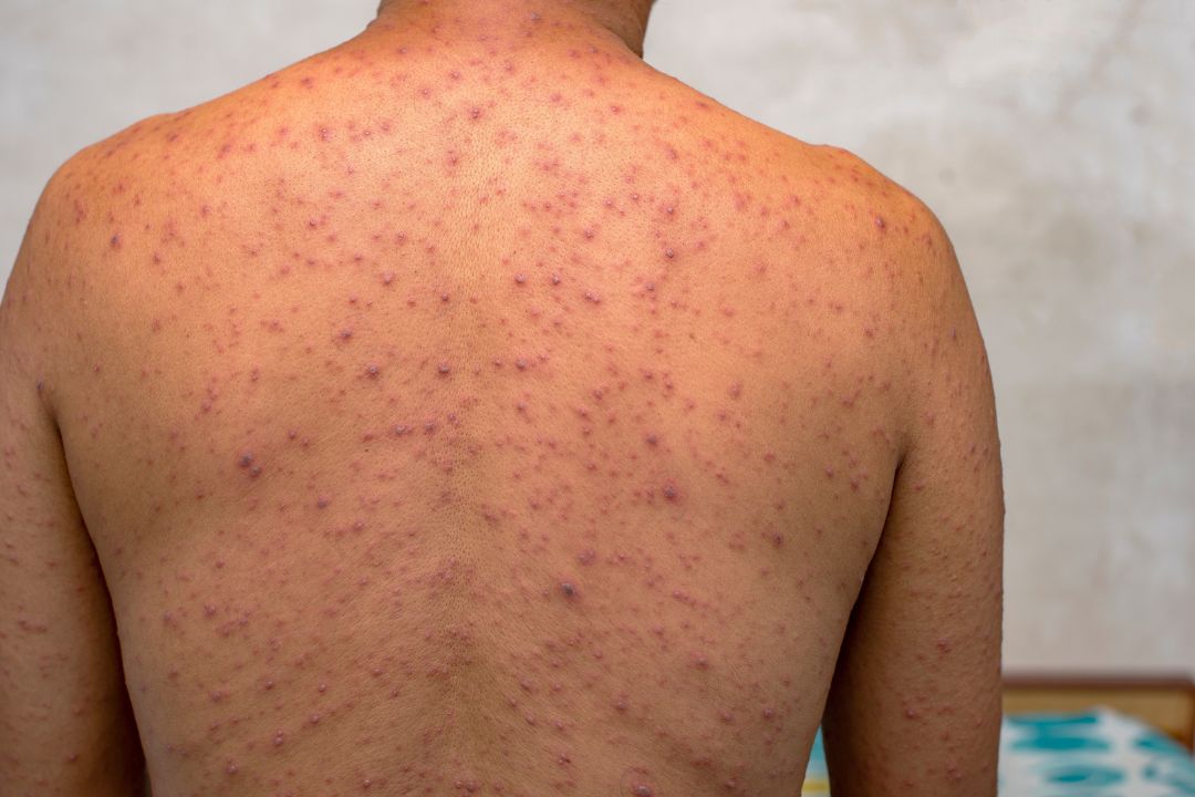 Someone infected with the monkeypox virus, Mpox