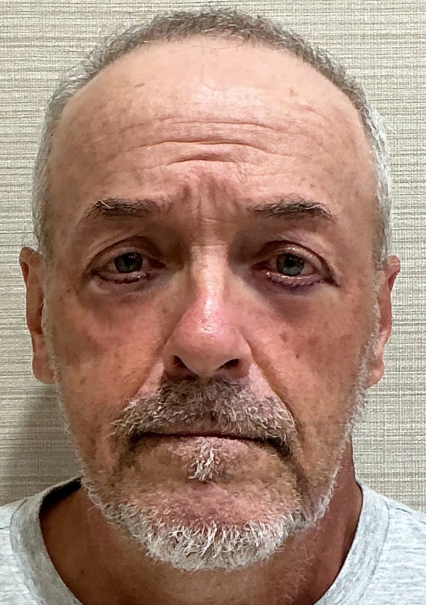 After Blepharoplasty