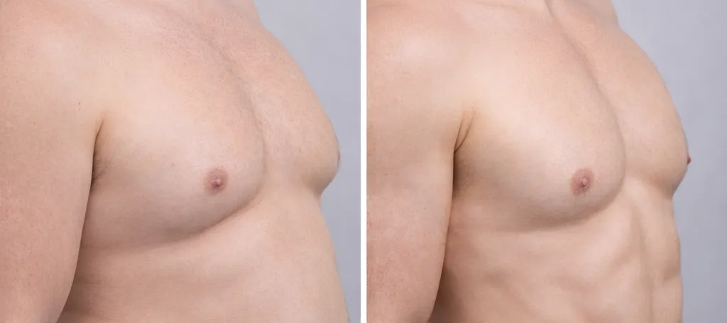 Liposukce pro muže: Tvarování mužského těla, odstranění tuku a techniky modelace