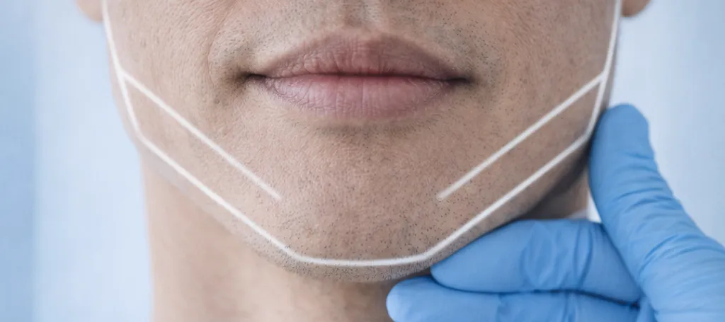 Masseter Botox pre mužov: Zoštíhlenie sánky, úľava od bruxizmu a rovnováha tváre