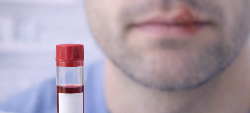 Herpes Testing for Men: Symptoms, Timing, Accuracy & Treatment Options