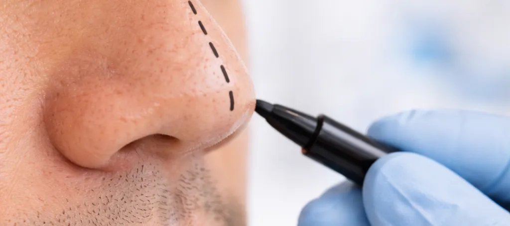 Rhinoplastika pro muže: Mužská úprava nosu, techniky, výhody a zotavení