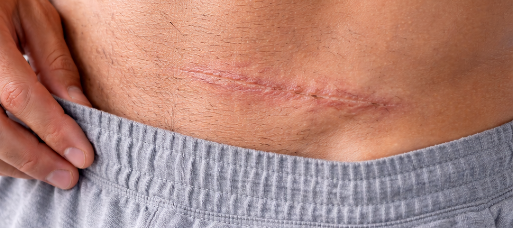 Male Scar Revision: Techniques to Improve Scars, Restore Confidence & Enhance Skin Appearance
