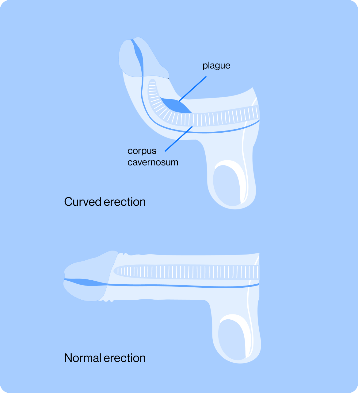 อะไรคือ ภาวะองคชาตโค้งงอ (Peyronie’s Disease) ?