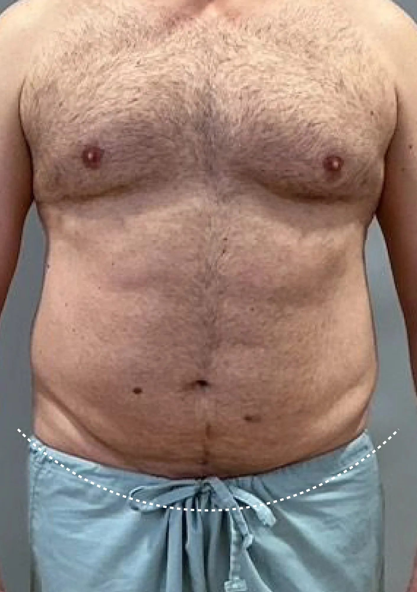 Before Liposuction