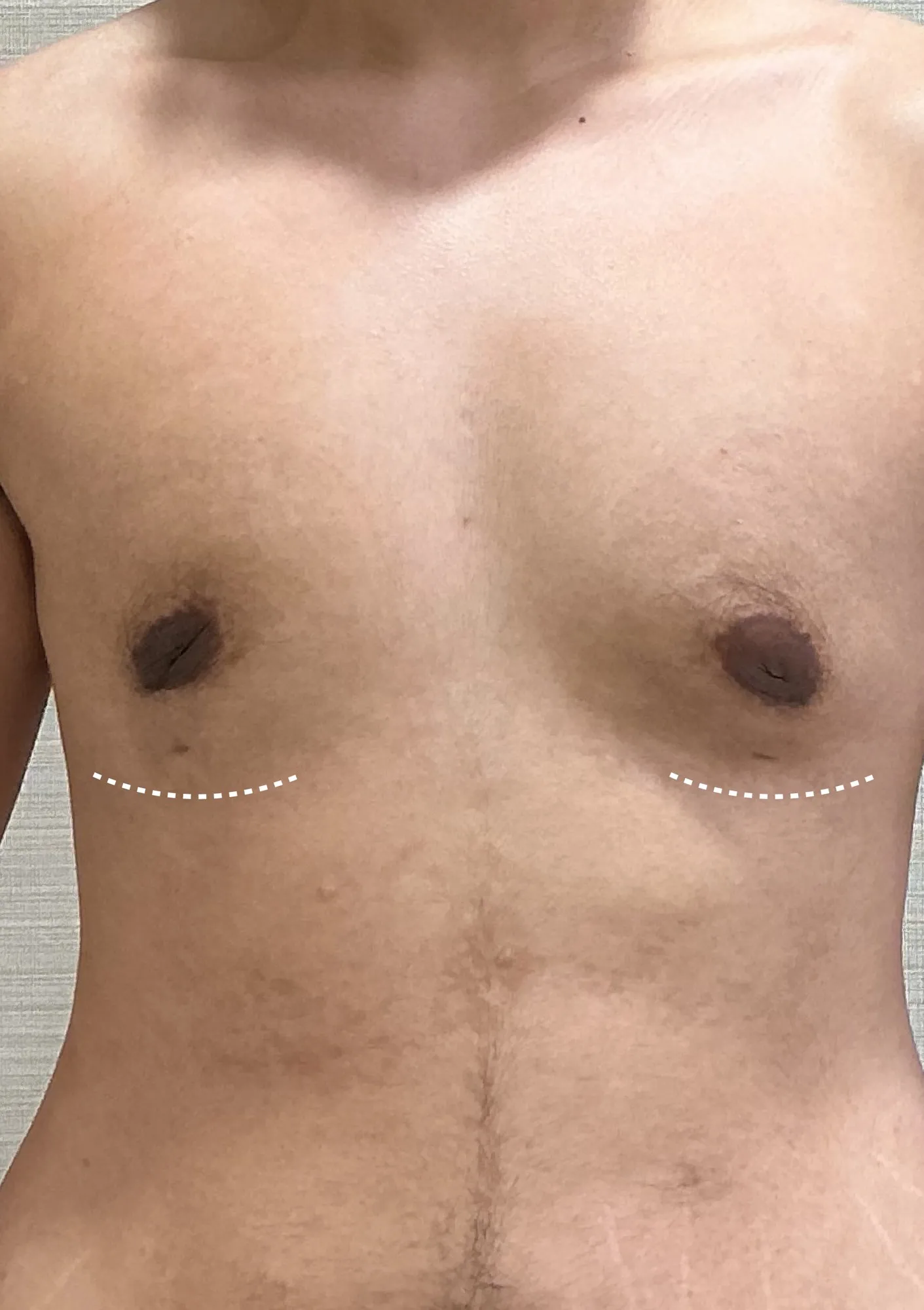 After Gynecomastia