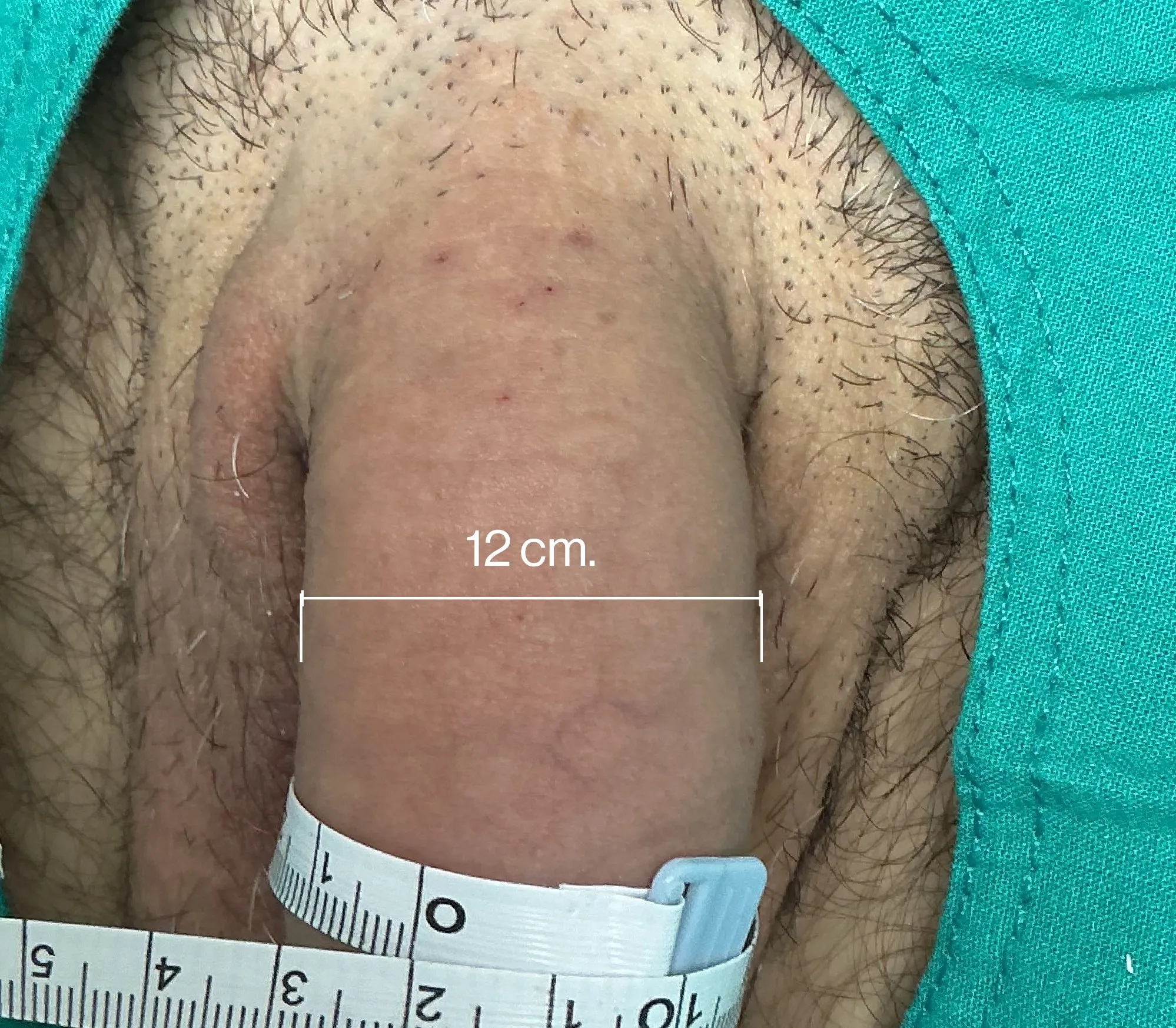 After Penile Filler