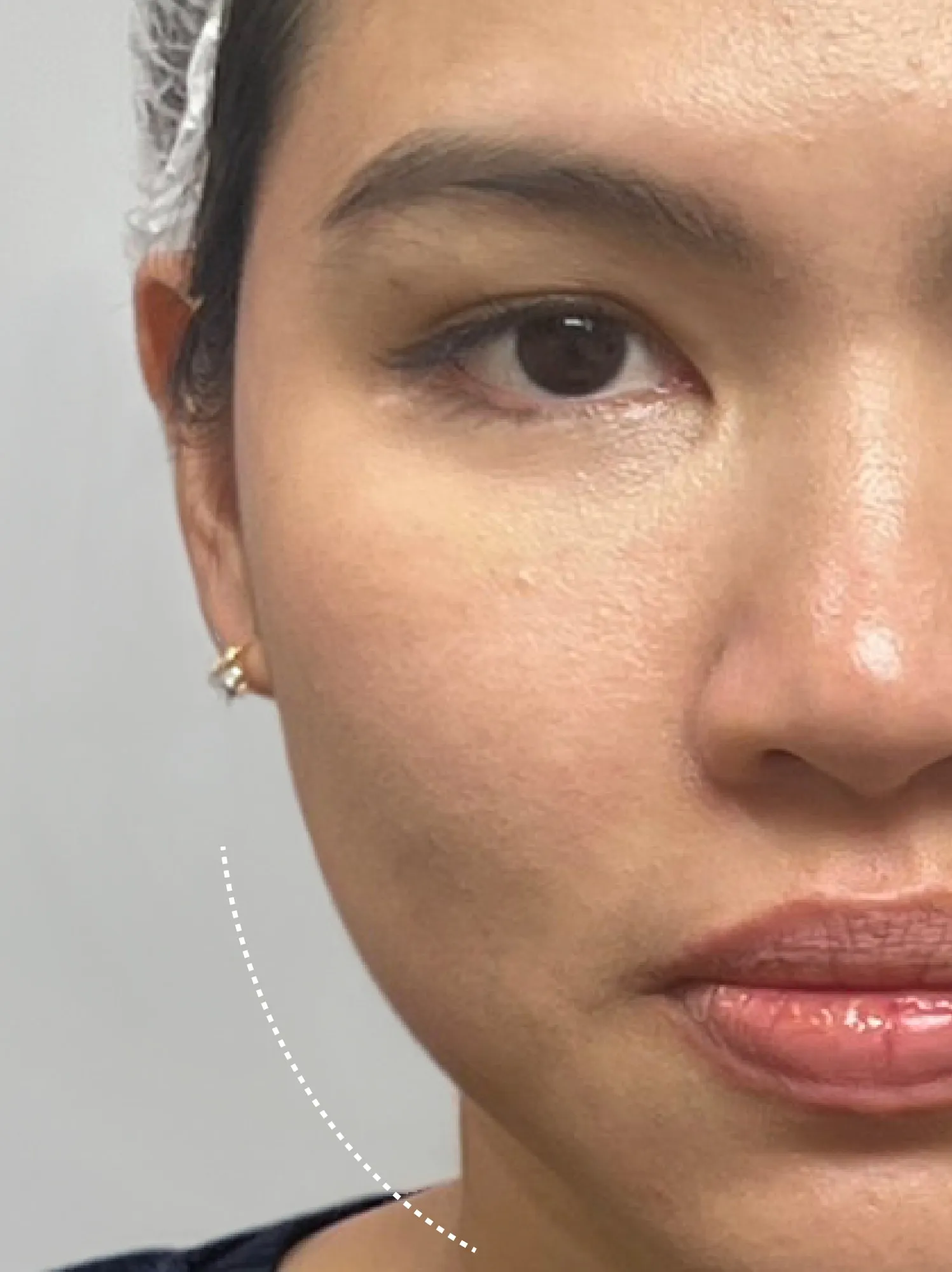 Before Sculptra treatment