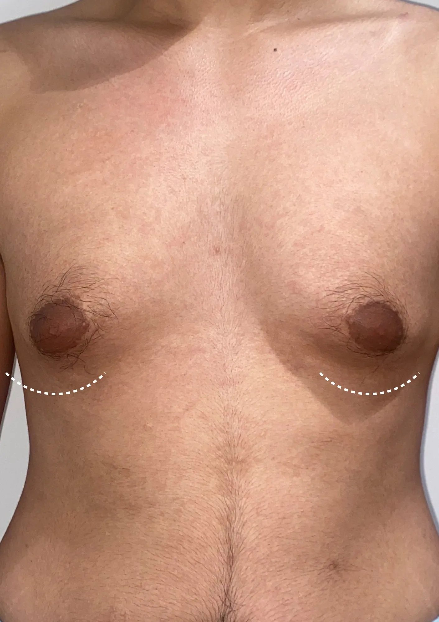 Before Gynecomastia