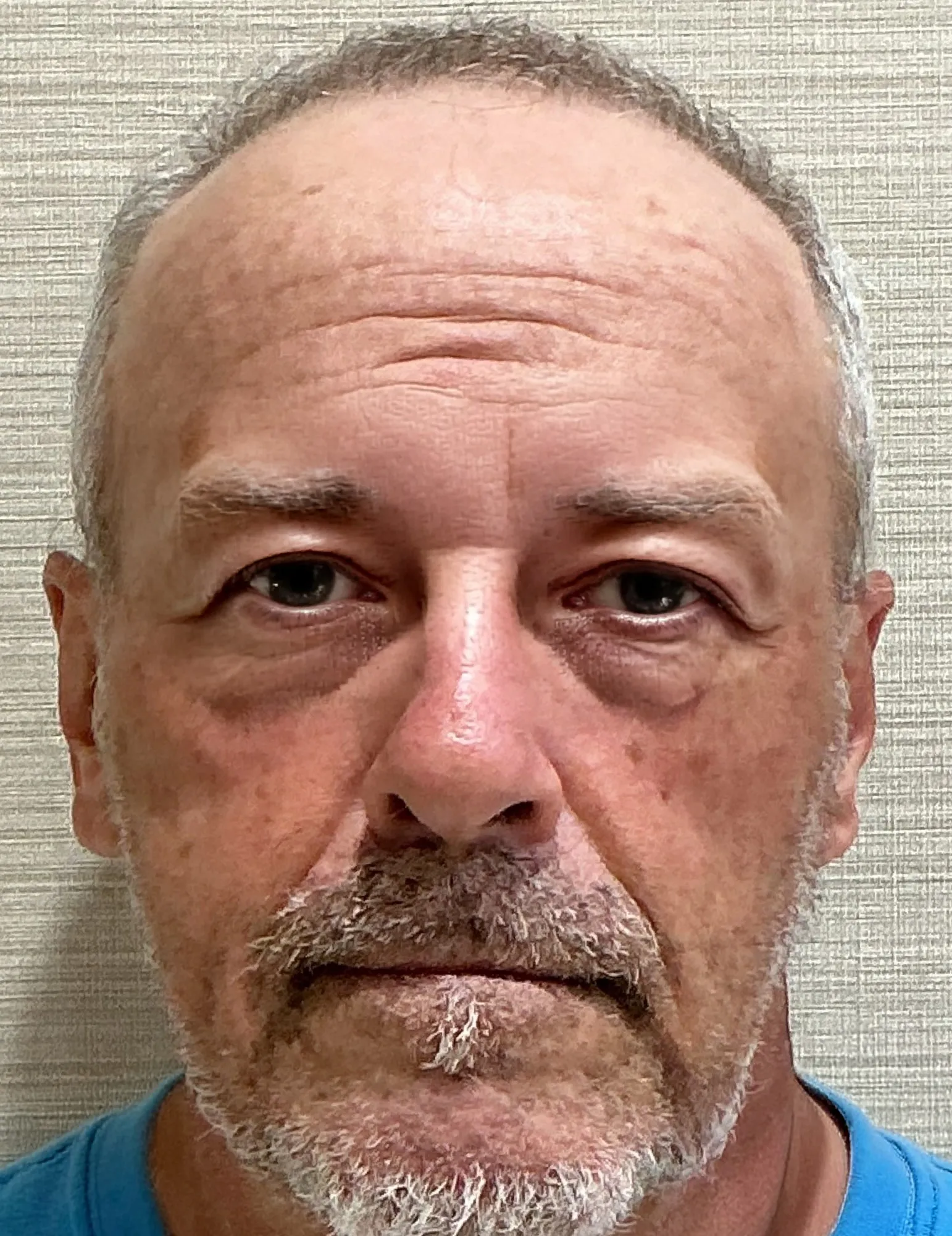 Before Blepharoplasty
