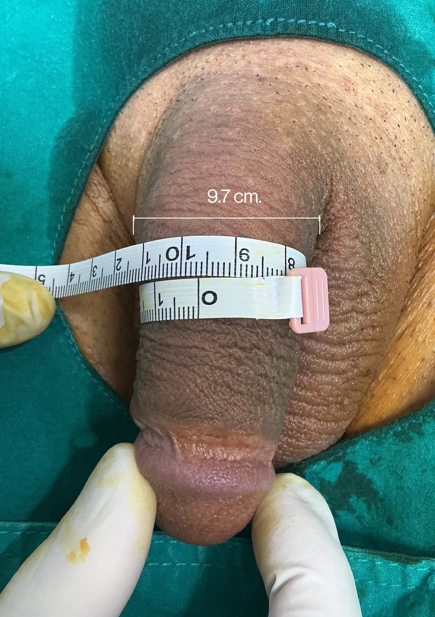 Before Penile Filler