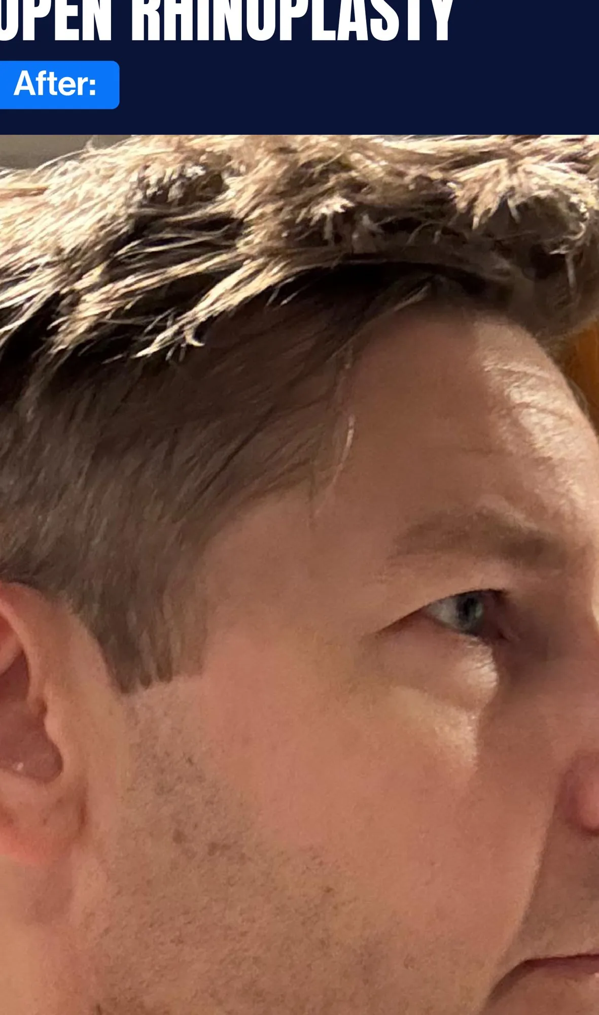 After Rhinoplasty