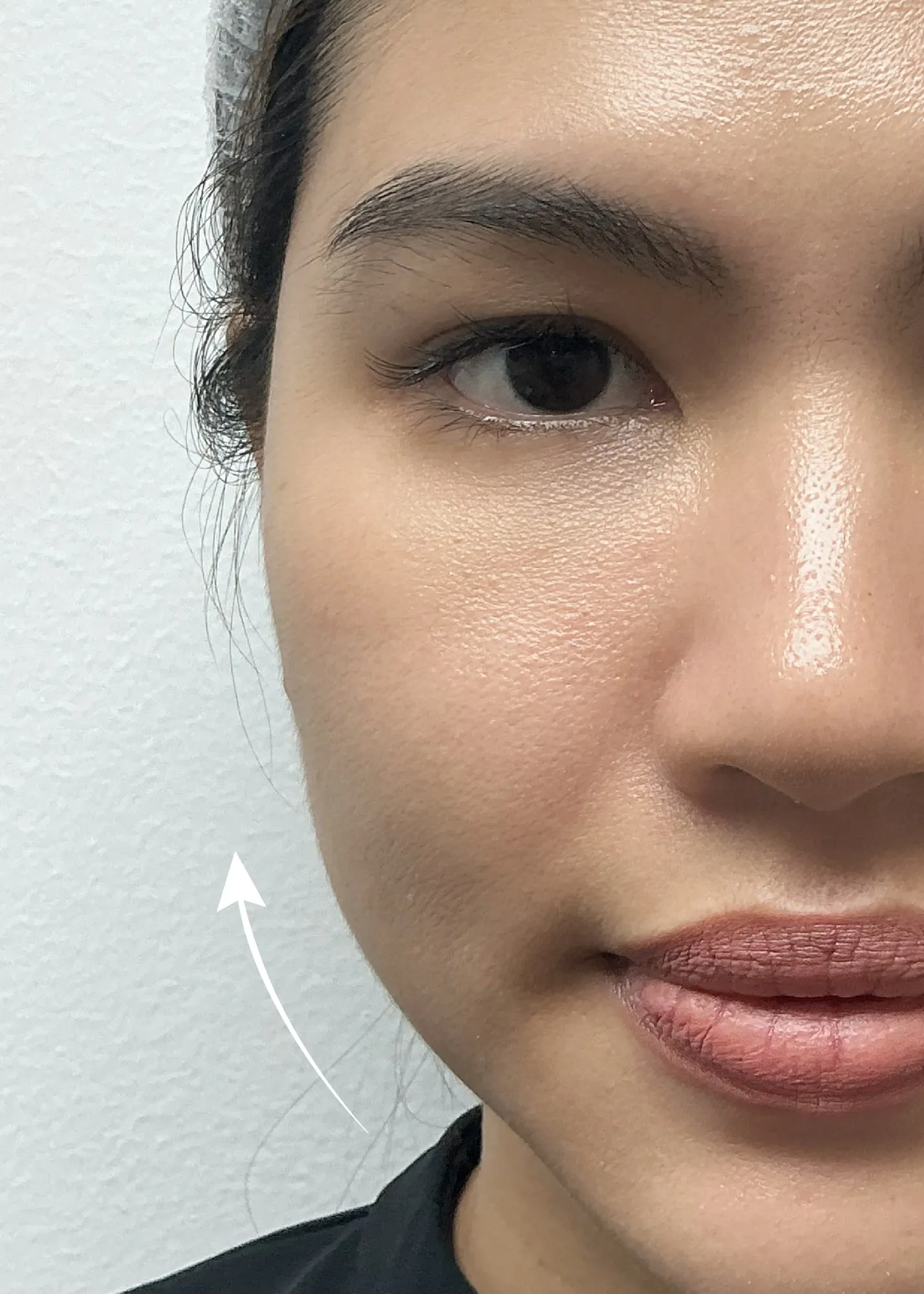 After Sculptra treatment