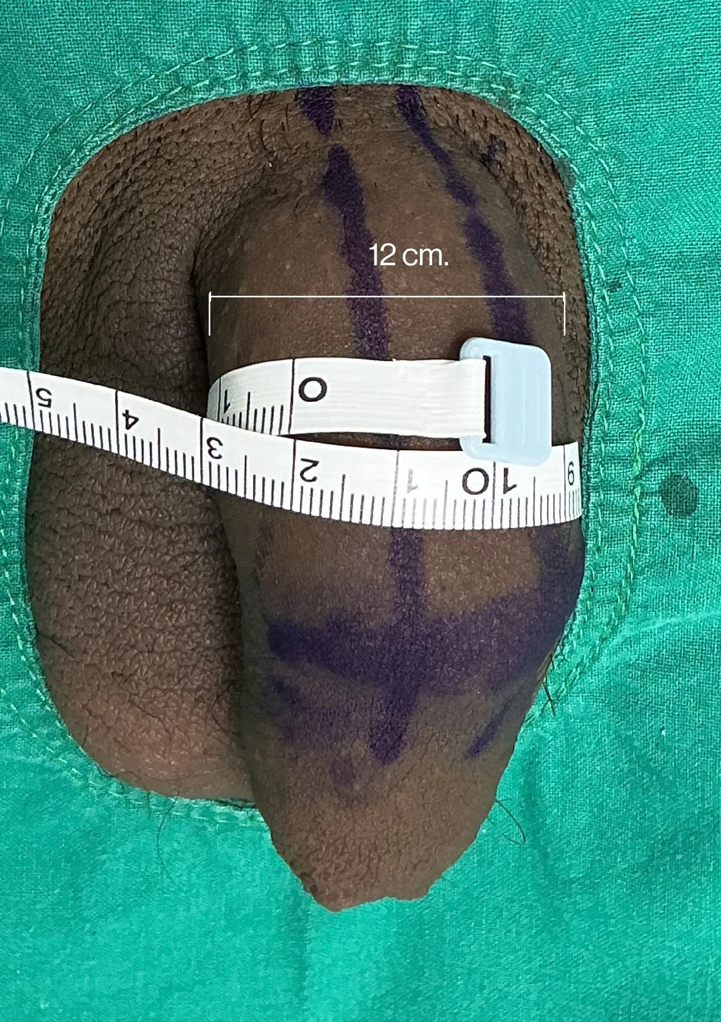 After Penile Filler