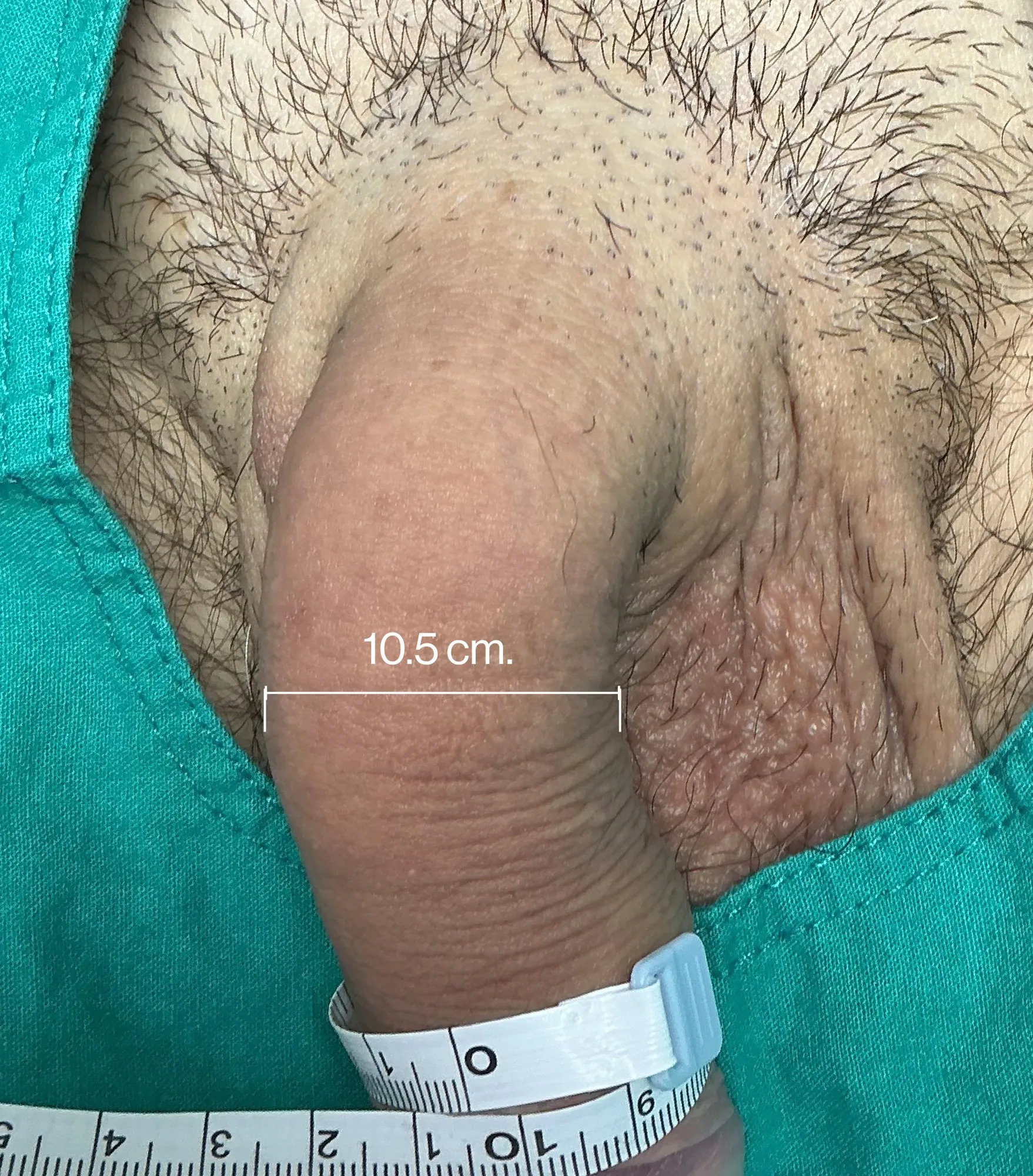 Before Penile Filler