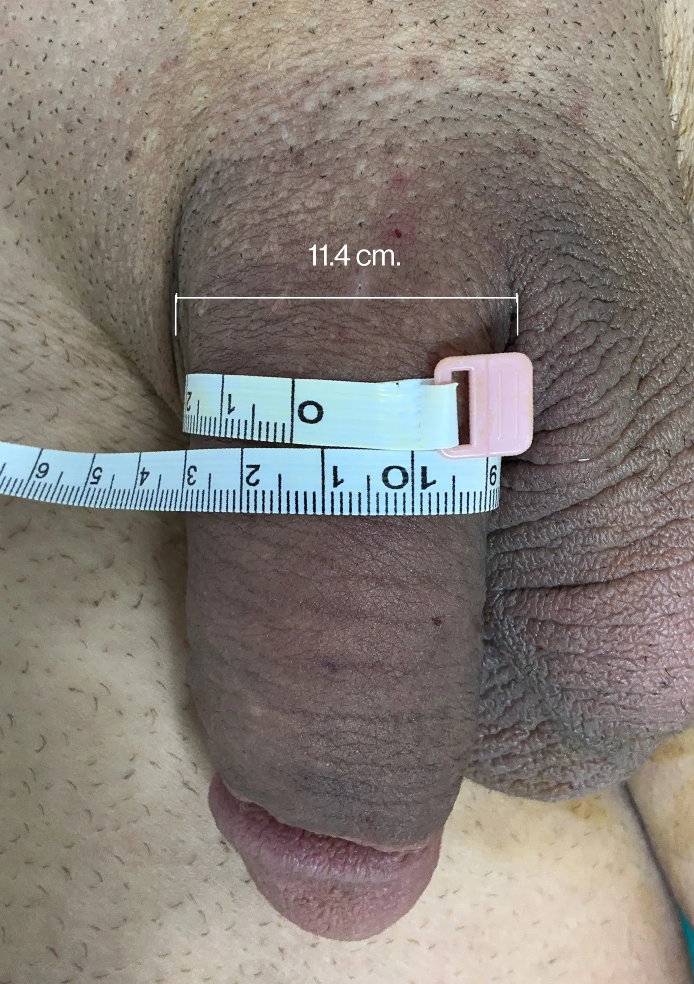 After Penile Filler