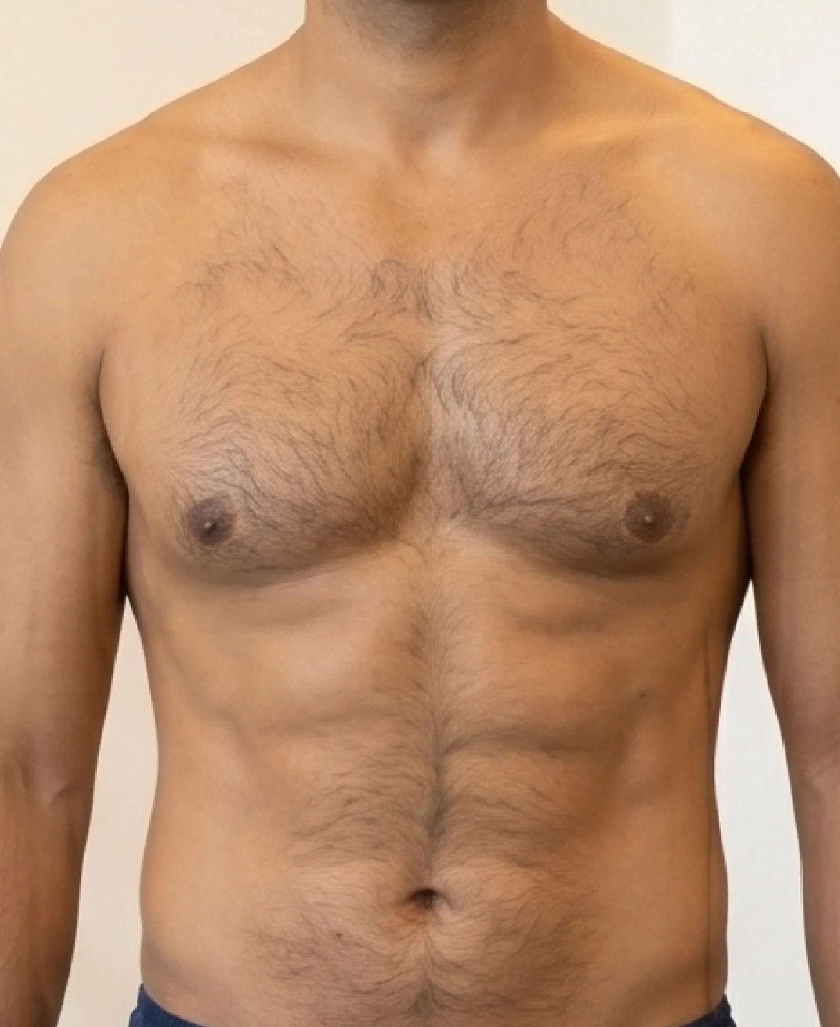 After Liposuction