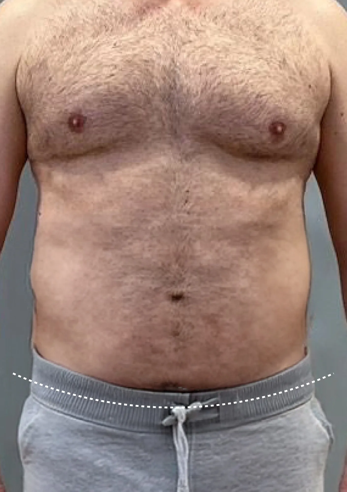 After Liposuction