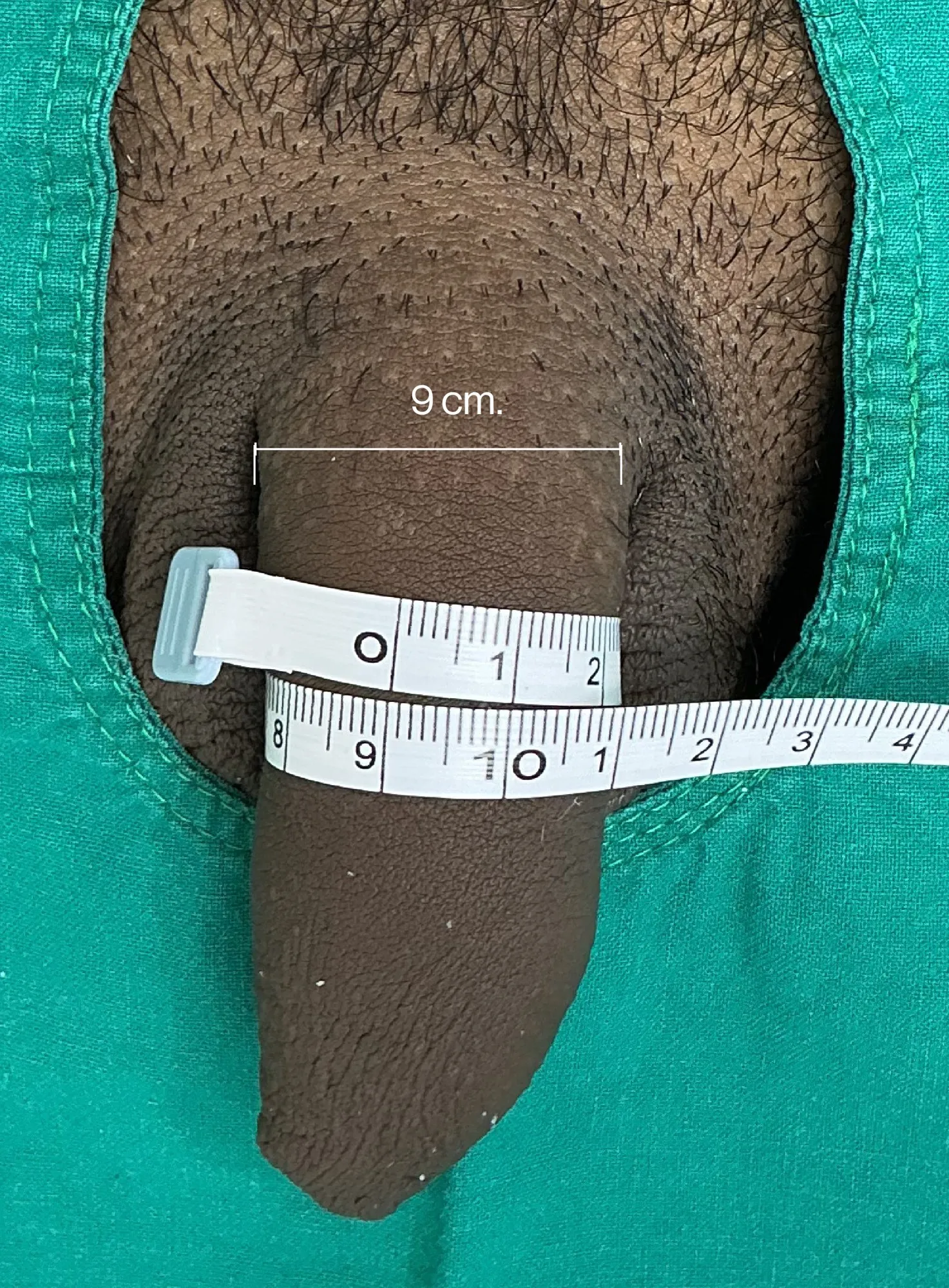 Before Penile Filler
