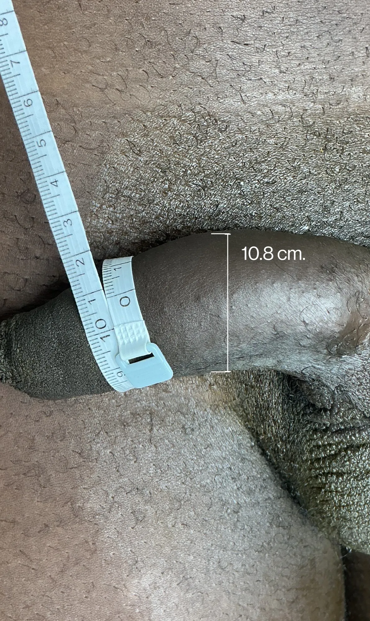 Before Penile Filler