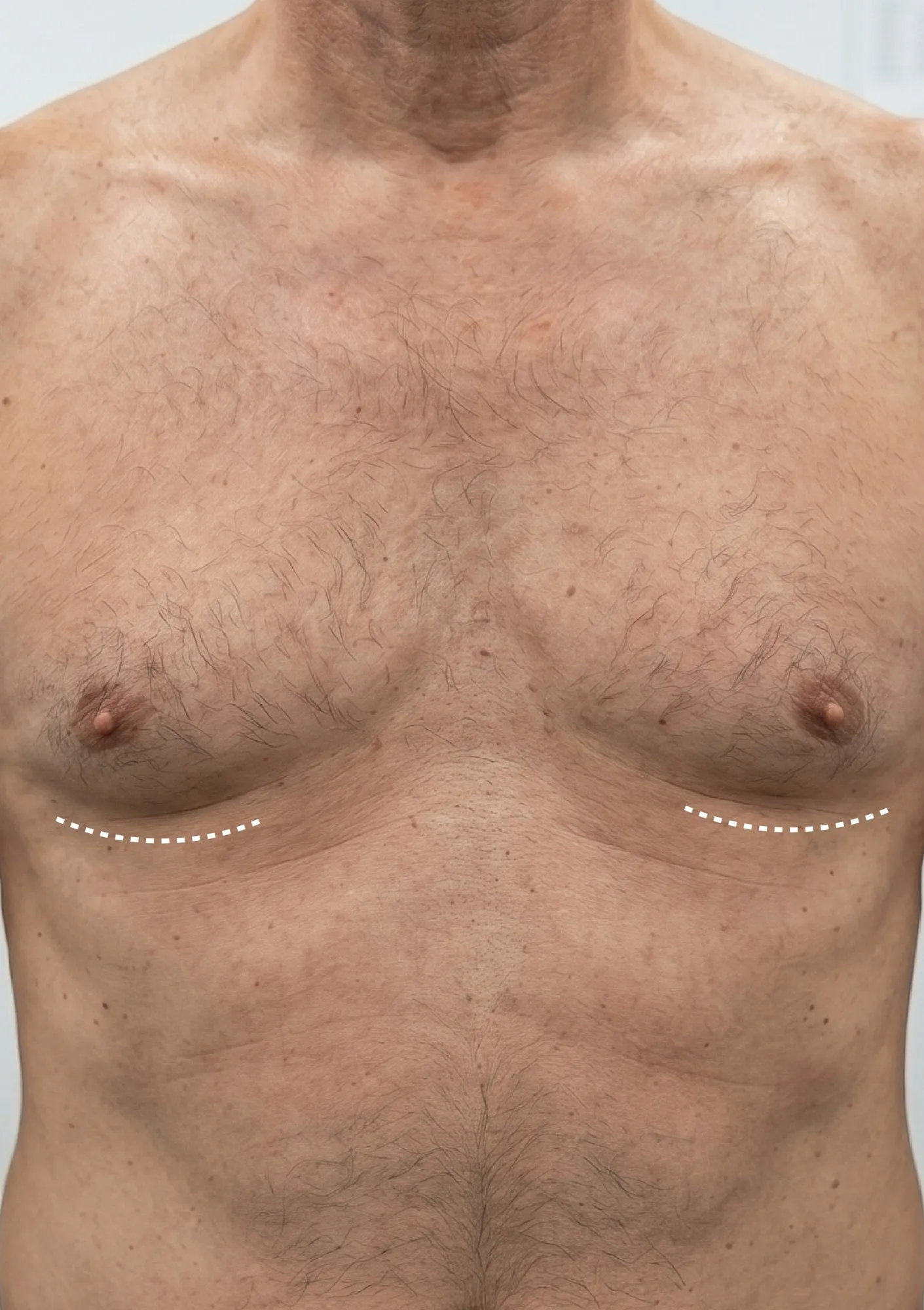 After Gynecomastia