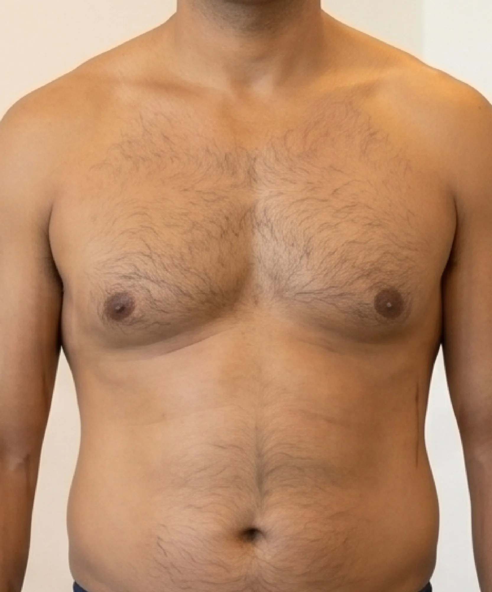 Before Liposuction