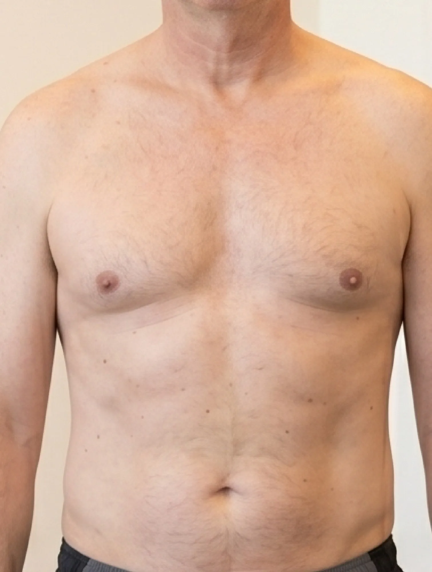 After Liposuction