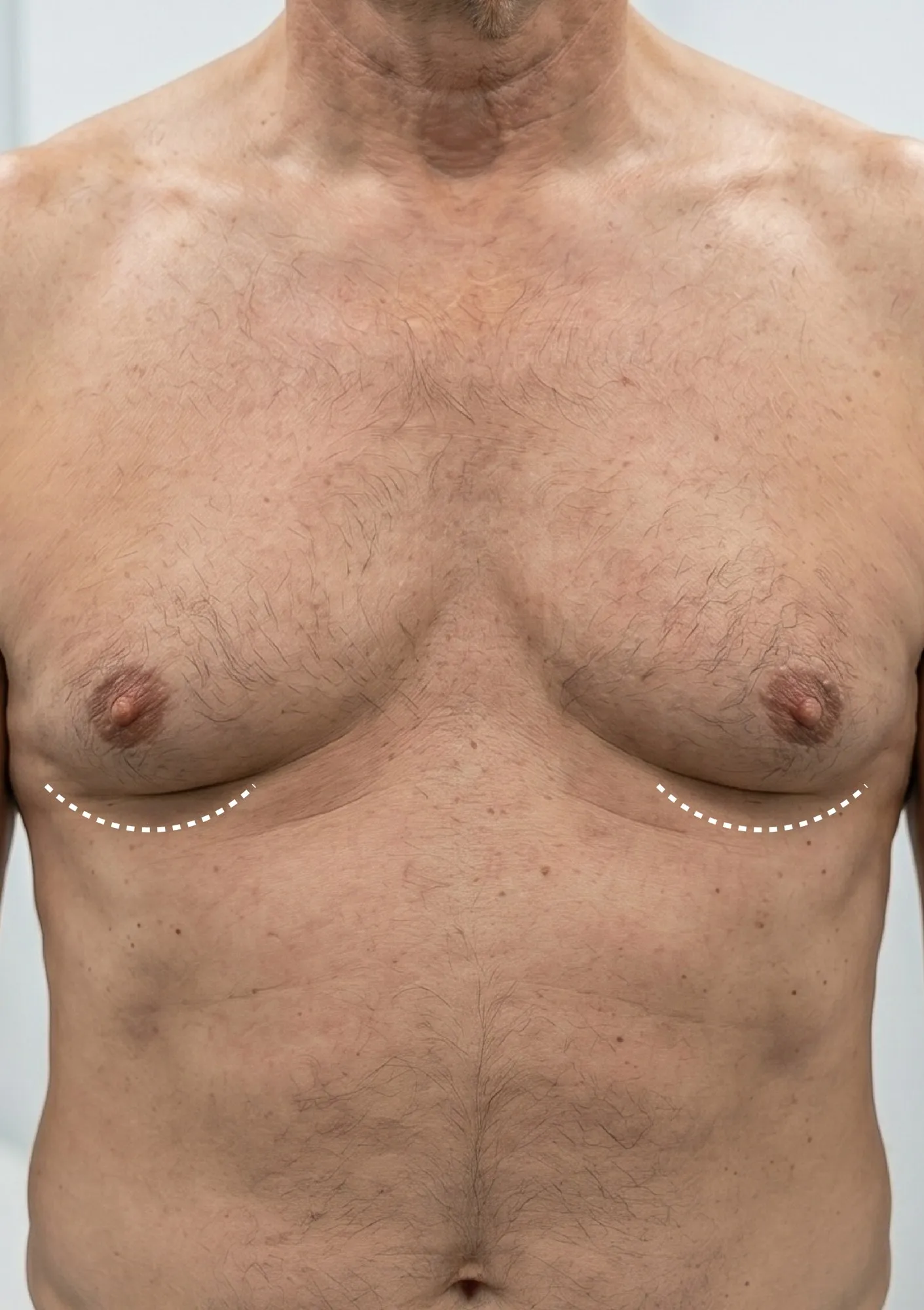 Before Gynecomastia